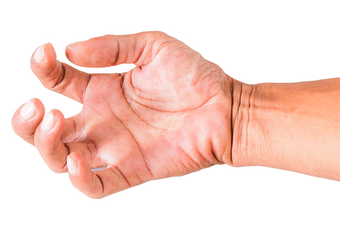 dupuytren-contracture-a-connective-tissue-disorder-dream-health